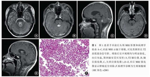 贝伐珠单抗是化疗吗_免疫治疗药物贝伐珠单抗_贝伐珠单抗靶向是啥