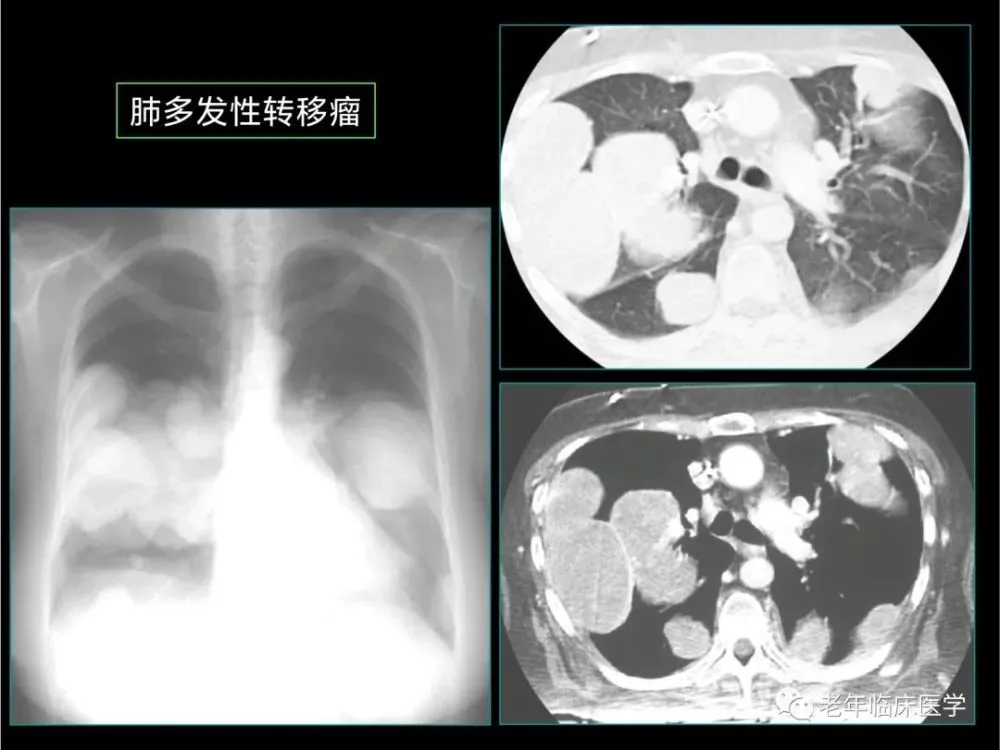 阿斯利康 奥希替尼_奥希替尼9291药品_奥希替尼治疗t790m