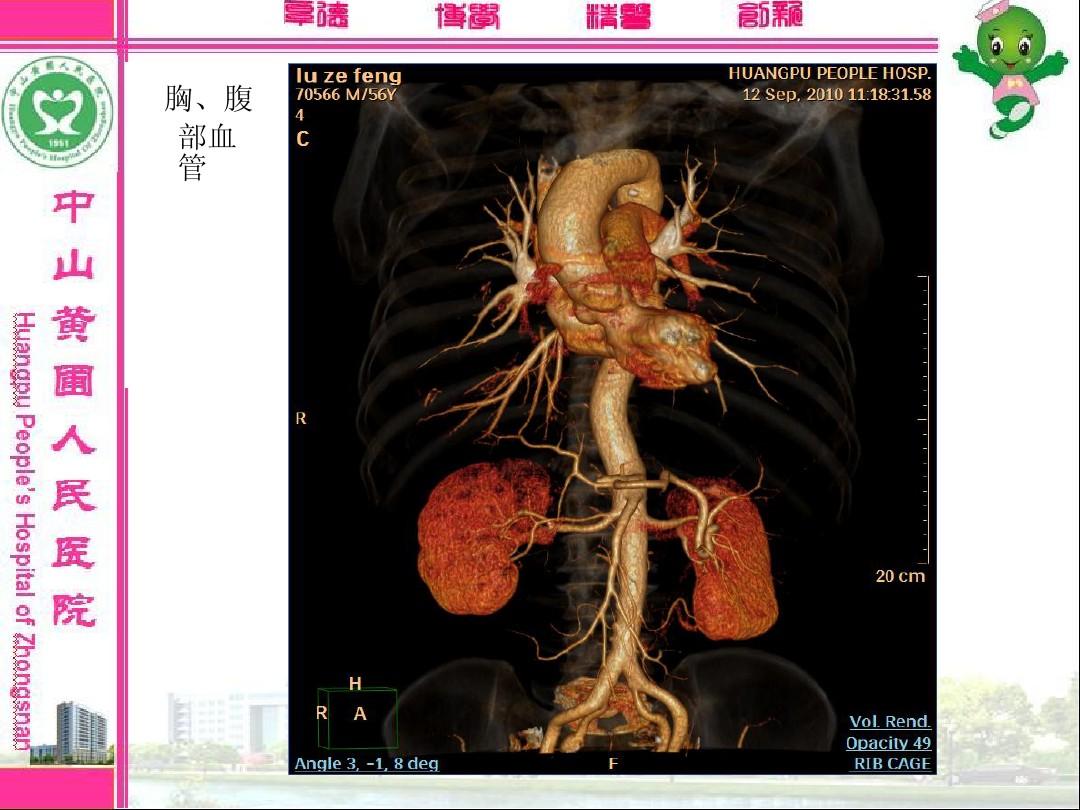 贝伐珠单抗多少钱一支_贝伐单抗治疗恶性胸腹水_贝伐单抗-阿瓦斯汀大陆卖多少钱?