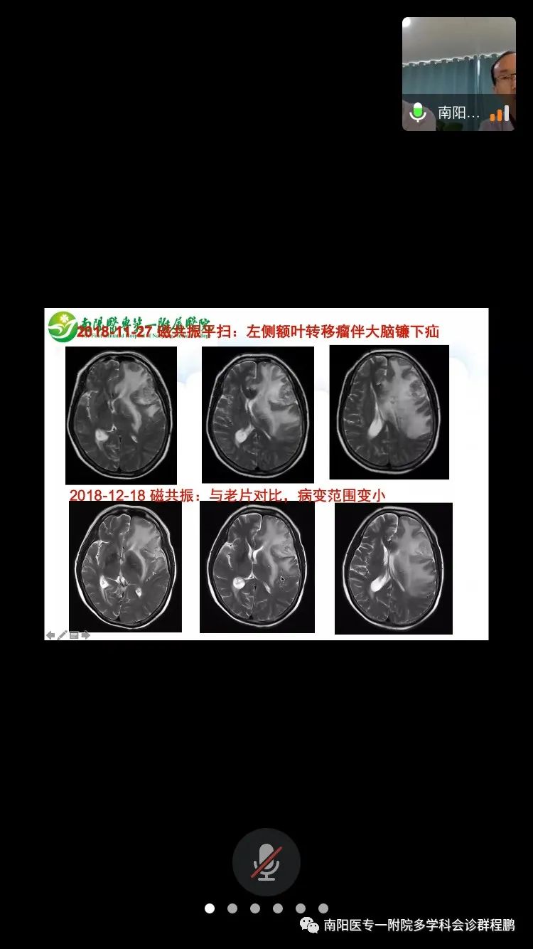 贝伐珠单抗靶向是啥_贝伐珠单抗_贝伐珠单抗治疗脑水肿用量