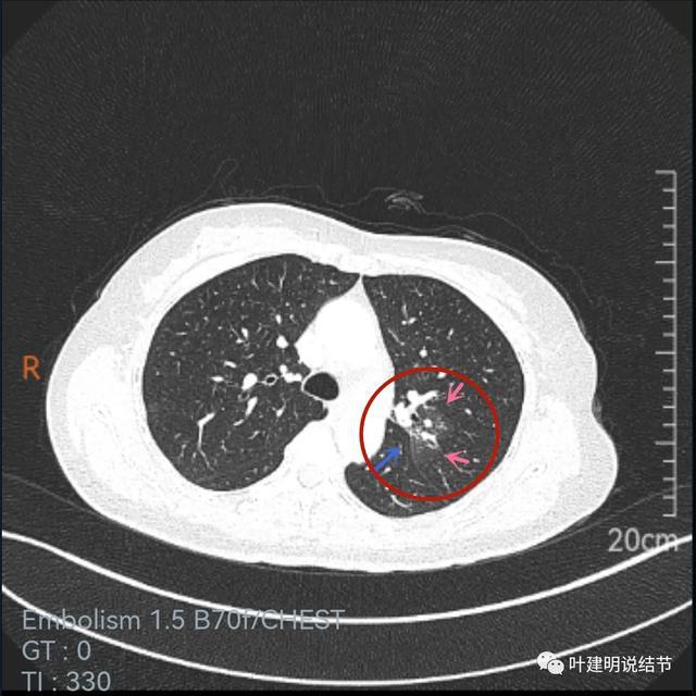 吃奥希替尼能把肿瘤吃没吗_奥希替尼都有哪里产的_奥斯替尼和奥希替尼