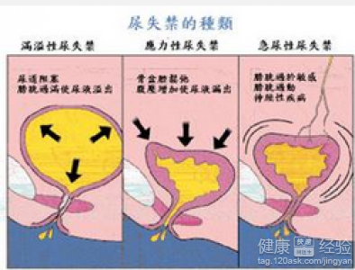 贝伐珠单抗治疗肺腺癌_贝伐珠单抗不良反应_贝伐珠单抗消除脑