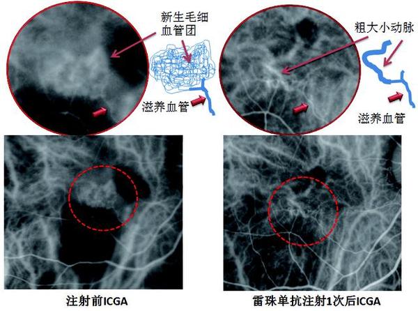 多吉美和贝伐珠单抗_贝伐珠单抗多少钱一支_贝伐珠单抗赠药