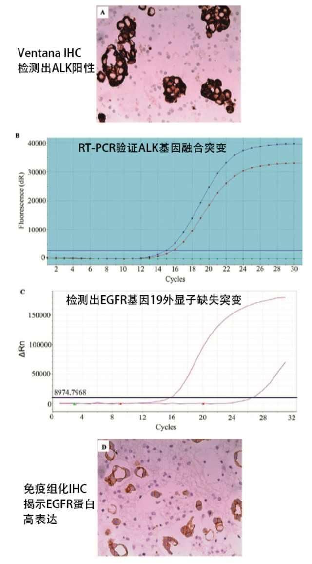 奥希替尼吃了两周没有反应_奥希替尼9291_奥希替尼印度版白盒