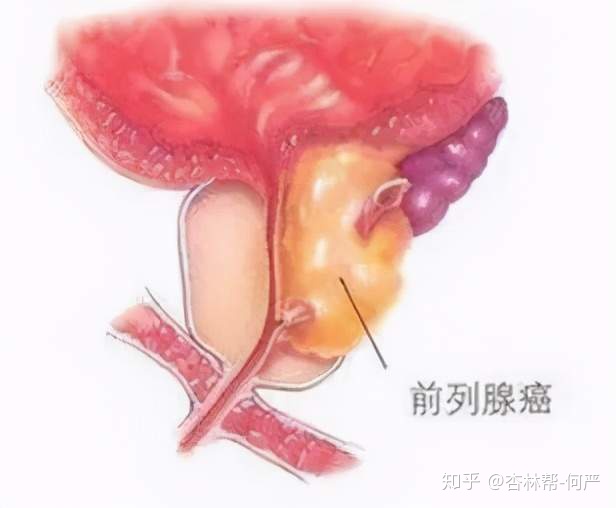 贝伐珠单抗注射液_贝伐单抗耐药性_奥拉帕尼十贝伐单抗治疗卵巢癌