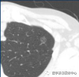 支气管粘液表皮样癌是类癌吗_吉非替尼是治什么癌_有哪些癌是懒癌