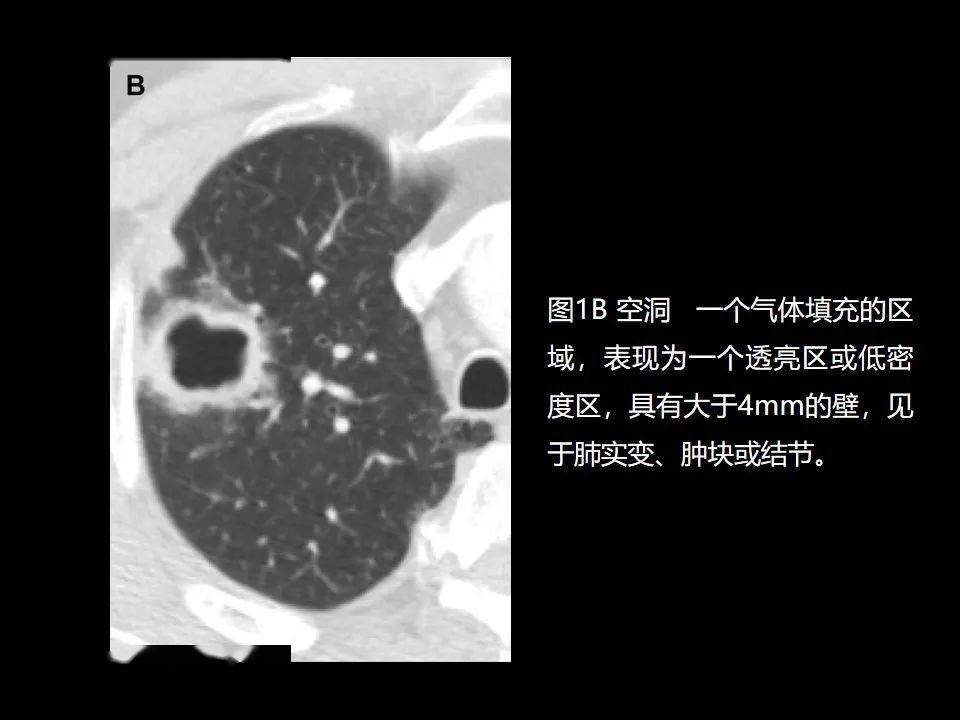 有哪些癌是懒癌_支气管粘液表皮样癌是类癌吗_吉非替尼是治什么癌