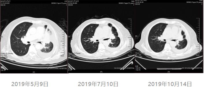 肠镜是癌而活检是癌怎么办_内膜癌1a期中分化术后癌栓怎治_吉非替尼是治什么癌