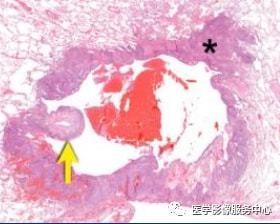 贝伐珠单抗_贝伐珠单抗可用于乳腺肺转移_贝伐单抗和贝伐珠单抗