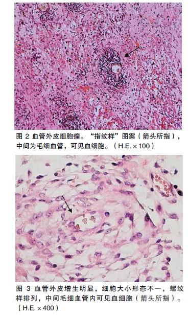 贝伐珠单抗是靶向药吗_贝伐珠单抗价格_贝伐单抗水肿症状没改善