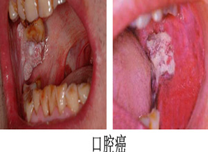 吃吉非替尼会导致口腔溃疡_百香果吃多了嘴巴会溃疡吗_十二指溃疡能导致大便黑吗