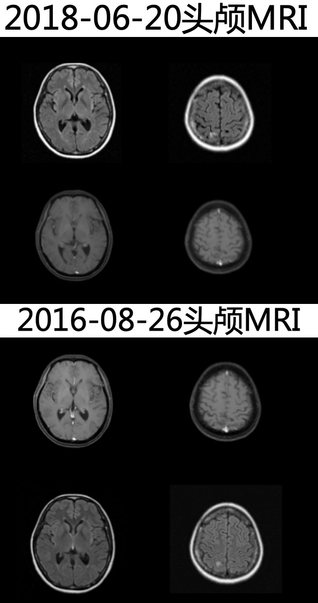 奥希替尼多少钱一盒_azd9291奥希替尼_奥希替尼入脑率