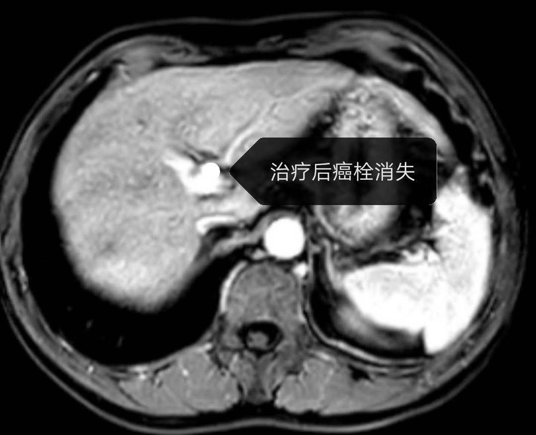 贝伐珠单抗是靶向药吗_贝伐单抗口腔炎_贝伐单抗-阿瓦斯汀大陆卖多少钱?