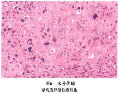 索拉非尼甲状腺癌_索拉非尼美国_索拉非尼 舒尼替尼