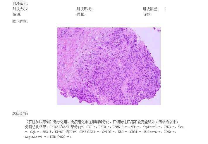 贝伐珠单抗_结肠癌腹腔灌注贝伐珠单抗_贝伐珠单抗是化疗药吗