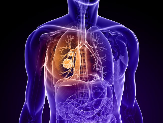 治疗肺癌效果理想的靶向药物-奥希替尼（泰瑞沙,奥斯替尼,塔格瑞斯）
