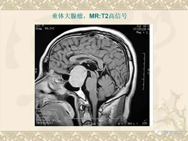 血管肉瘤贝伐单抗_贝伐珠单抗靶向是啥_贝伐珠单抗价格