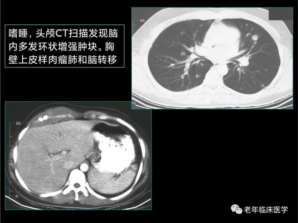 肺癌脑转移奥希替尼恢复_奥希替尼都有哪里产的_肺癌转移脑部的症状