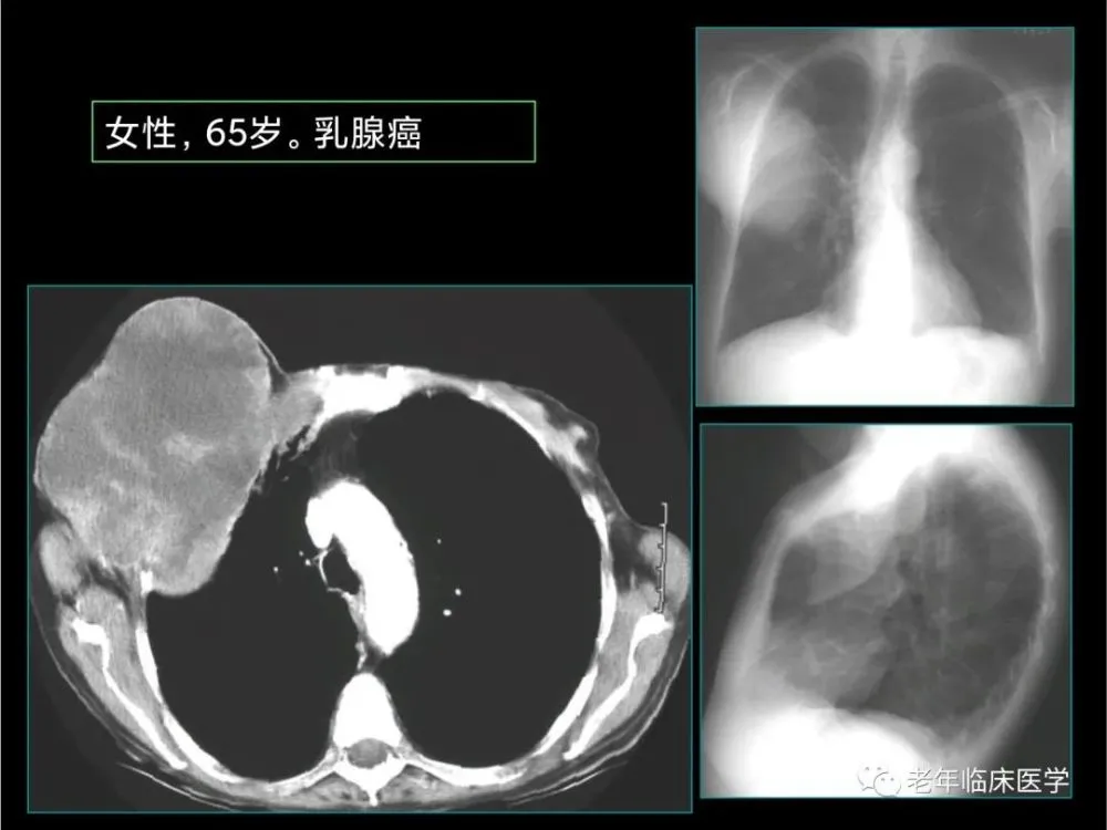 肺癌转移脑部的症状_肺癌脑转移奥希替尼恢复_奥希替尼都有哪里产的