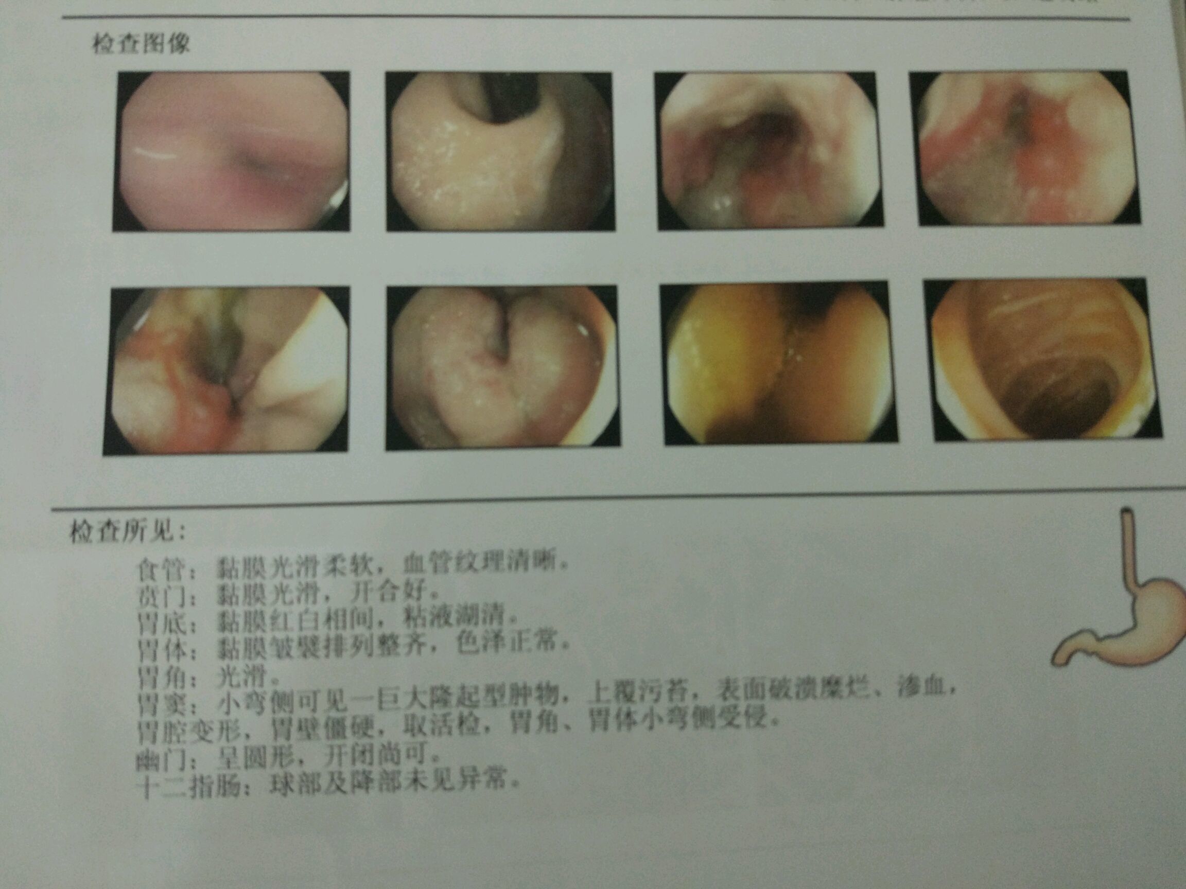 索拉非尼 手术_肝癌的索拉非尼_肝癌手术后切除后服用索拉非尼