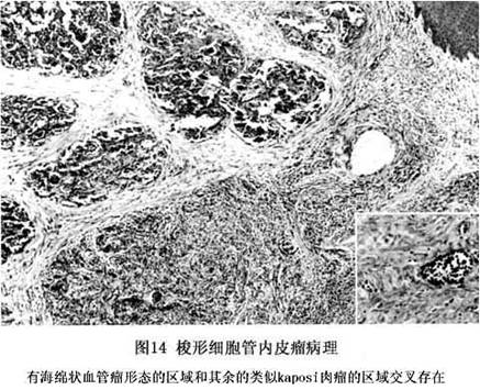 贝伐单抗加靶向药物_贝伐单抗耐药性_贝伐珠单抗靶向是啥