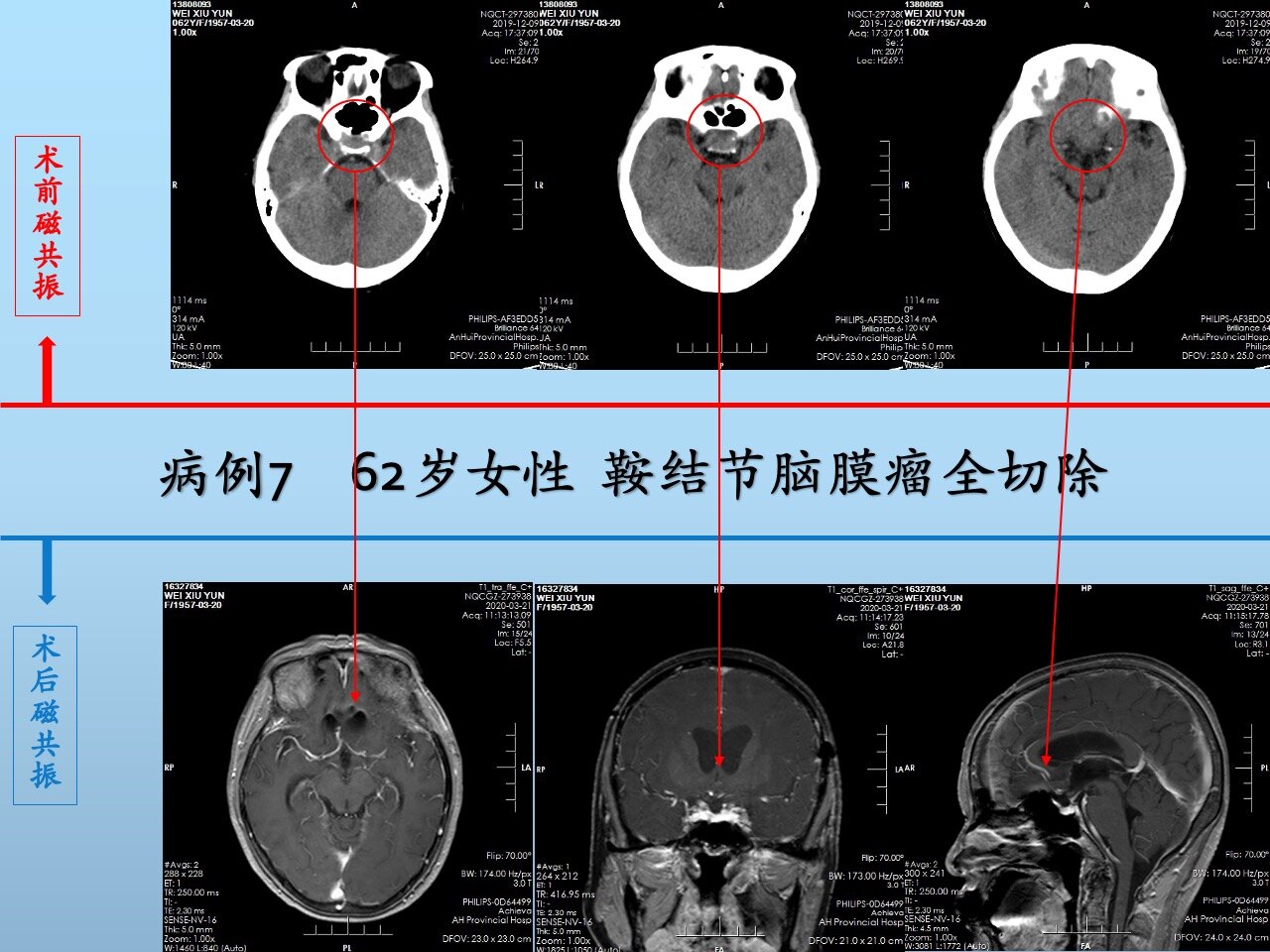 贝伐单抗-阿瓦斯汀大陆卖多少钱?_贝伐单抗是靶向药吗_贝伐单抗对恶性脑水肿