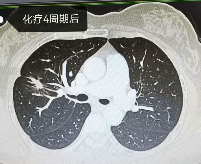 贝伐珠单抗是化疗药吗_肺腺癌贝伐单抗_贝伐珠单抗注射液