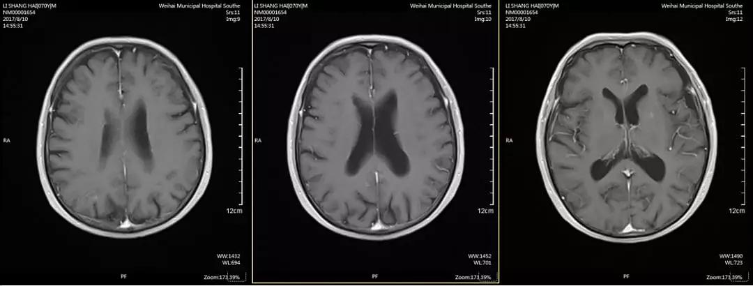 贝伐珠单抗肺癌临床研究_贝伐珠单抗_贝伐珠单抗多少钱一支