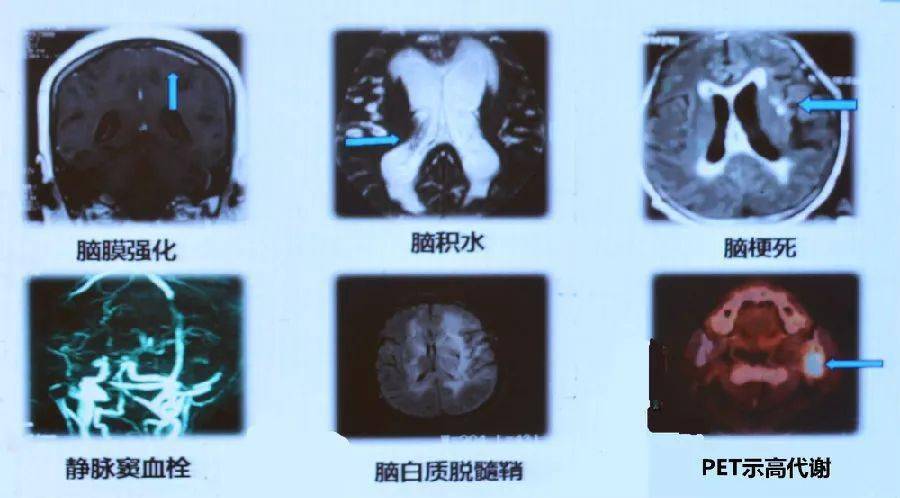 奥希替尼9291_奥希替尼脑膜转移用量分两次_中国版奥希替尼