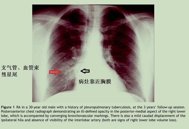 奥希替尼耐药后第四代靶向药_肺癌术后奥希替尼辅助治疗_早期肺癌术后不治疗能活多久