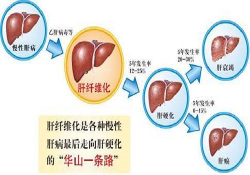 肝癌早期肚子胀能吃索拉非尼吗_肝癌晚期肚子胀怎么办_肝癌索拉非尼效果