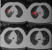 azd 9291 奥希替尼_奥希替尼对肺癌胸膜侵犯有效吗_奥希替尼都有哪里产的