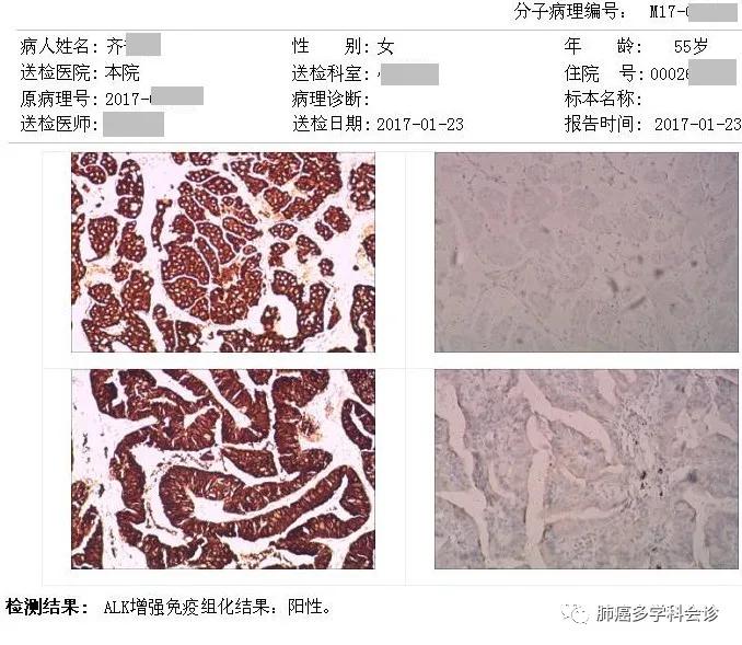 印度9291奥希替尼图片_奥斯替尼和奥希替尼_奥希替尼的肌酸激酶