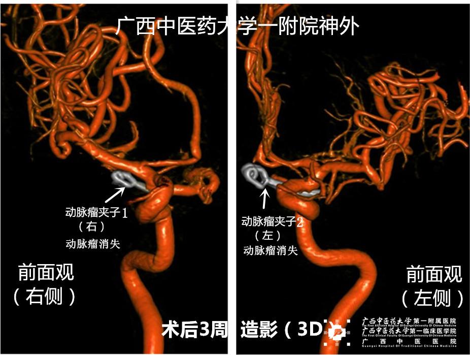 贝伐单抗用多久会耐药_脑干胶质瘤用贝伐单抗_贝伐单抗耐药性