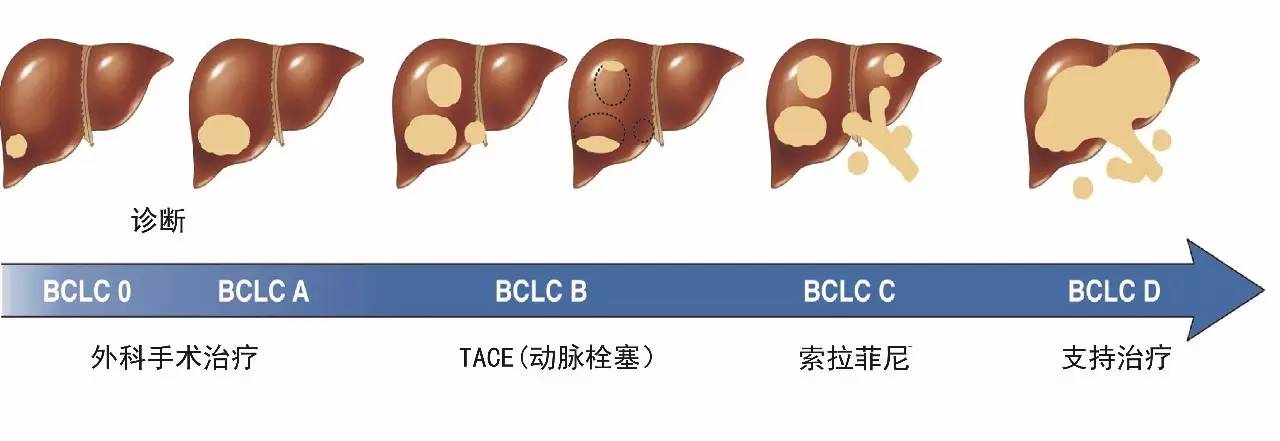 索拉非尼无法手术_索拉非尼价格_索拉非尼说明书