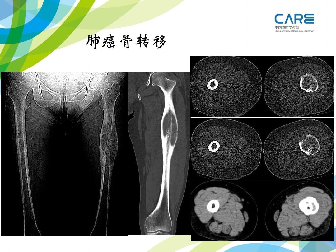 肺原位腺癌会复发吗_肺腺癌晚期喝吉非替尼又复发_子宫内膜浆液腺癌术后复发怎么办