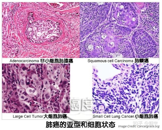 中国版奥希替尼_奥希替尼都有哪里产的_肺间质性感染能吃奥希替尼吗