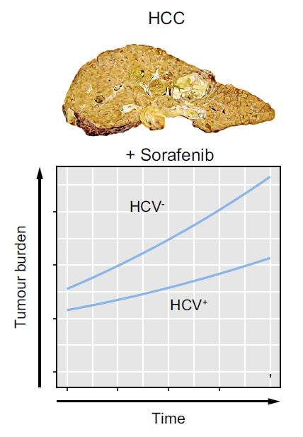 索拉菲尼与肝癌_索拉非尼治疗肝癌真实故事_索拉非尼肝癌延长时间