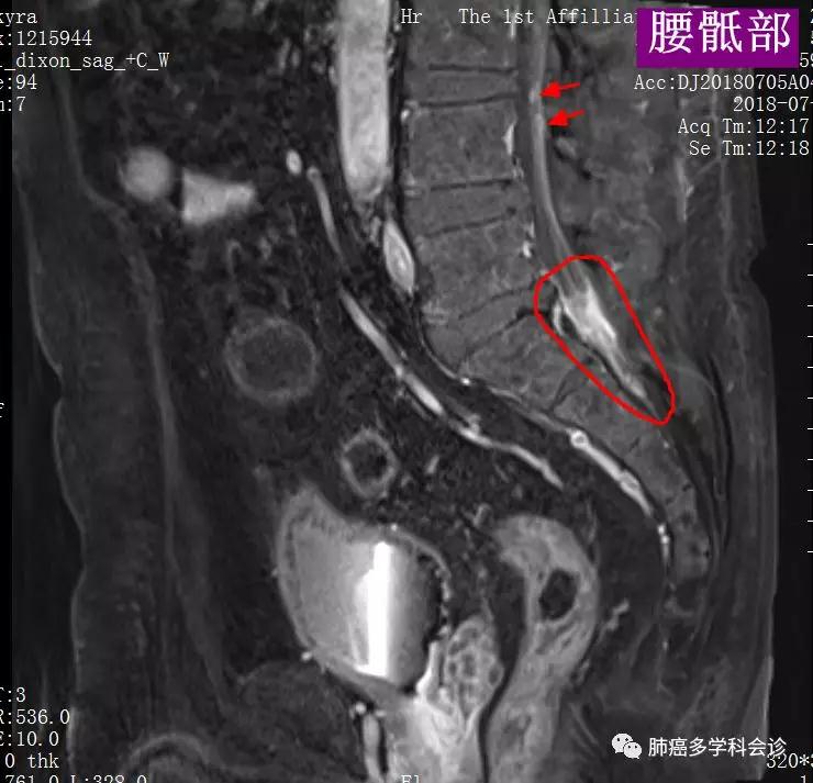 奥希替尼治疗肺腹水_azd 9291 奥希替尼_奥希替尼印度版怎么买