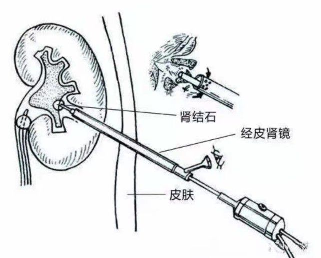 贝伐珠单抗是化疗药吗_贝伐珠单抗注射液_贝伐单抗可以治疗肾癌吗