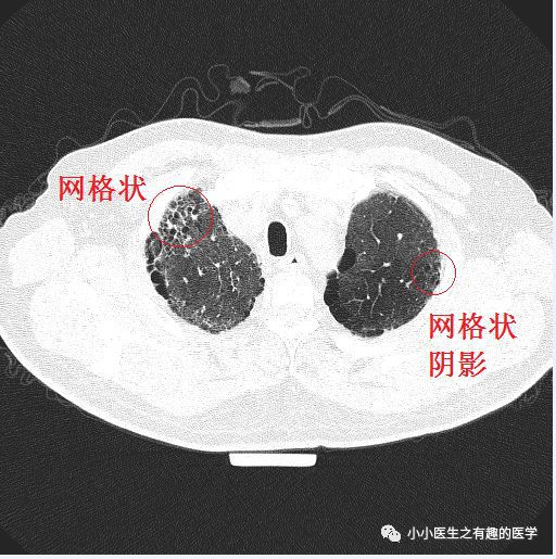 吉非替尼间质性肺炎_间充质干细胞培养基_间充质干细胞疗法