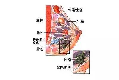 贝伐单抗单药治疗乳腺癌_贝伐单抗联合靶向药_贝伐单抗治疗哪种癌症