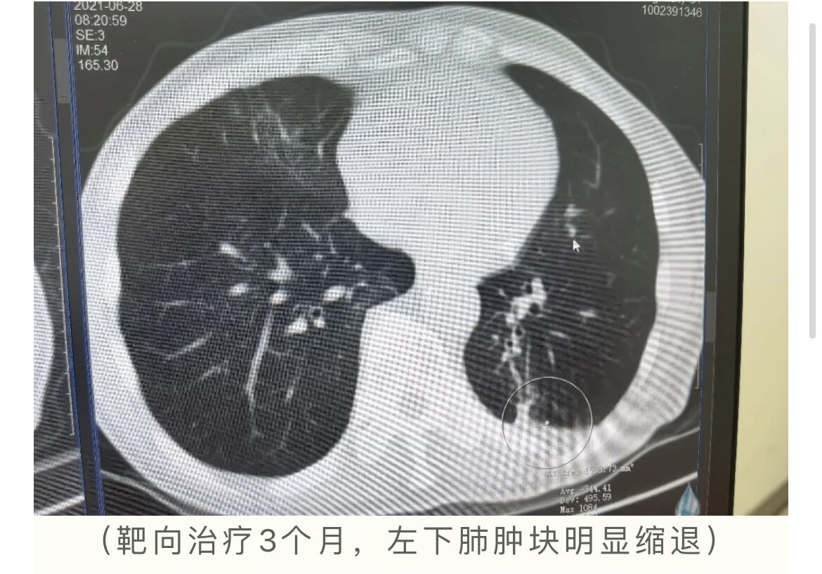 吉非替尼片鳞状细胞癌_子宫颈抹片检查报告有鳞状细胞_鳞状上皮细胞癌