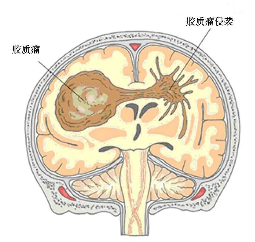 贝伐珠单抗用于低级别胶质瘤_贝伐珠单抗多少钱一支_贝伐珠单抗4个月后赠药