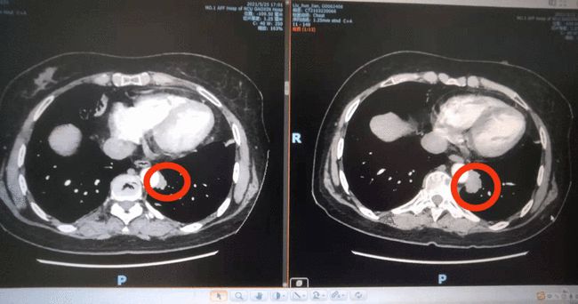 奥希替尼都有哪里产的_二线治疗奥希替尼_azd9291奥希替尼