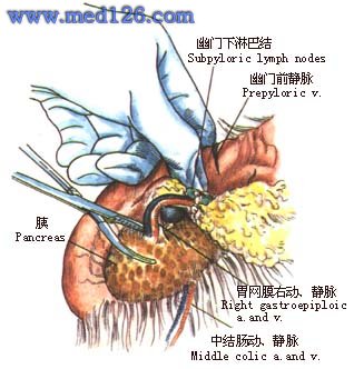 胃肠间质瘤索拉非尼_胃肠间质瘤 专家_胃肠间质瘤能治好吗