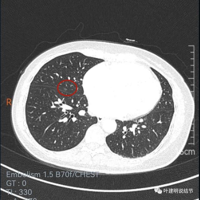 阿斯利康的奥希替尼多少钱_印度9291奥希替尼图片_中国版奥希替尼