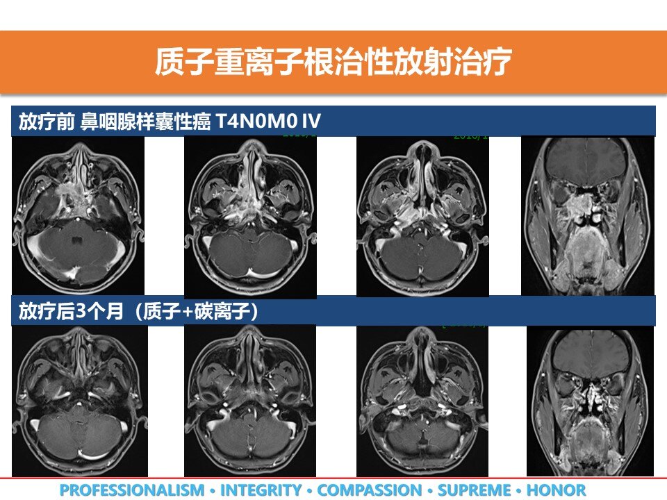 贝伐珠单抗是化疗吗_贝伐珠单抗价格_腺样囊性癌用贝伐珠单抗