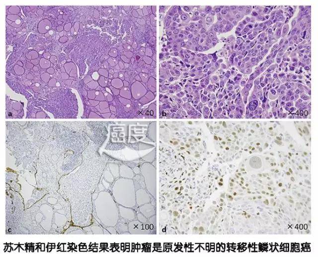 浸润性腺癌肺5年存活率_肺乳头状腺癌恶性程度_肺腺癌服用吉非替尼