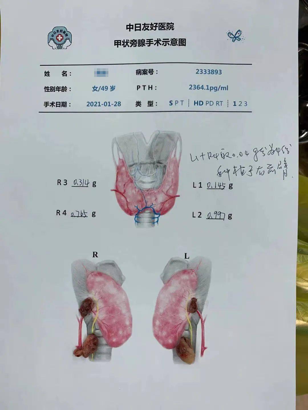 贝伐单抗耐药性_贝伐珠单抗_什么情况下用贝伐单抗